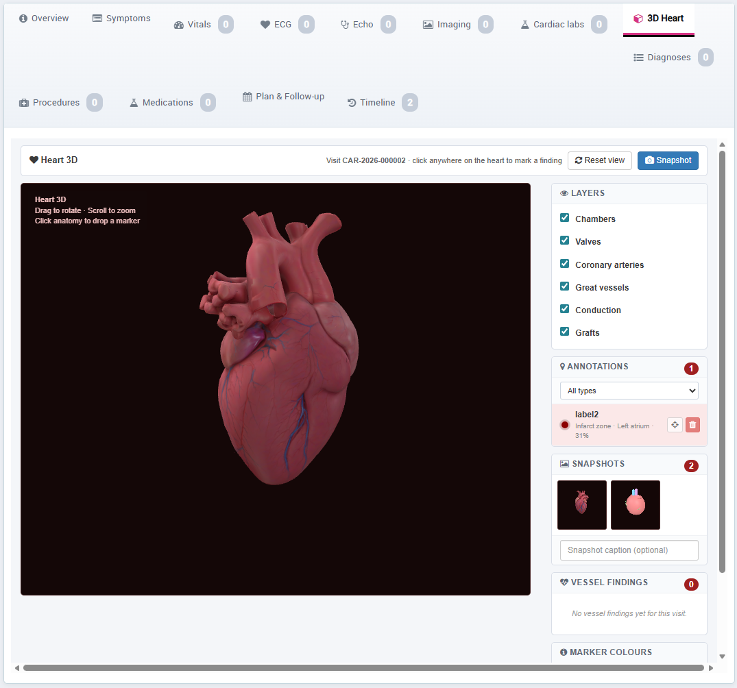 3D Heart anatomical model with stenosis annotation panel